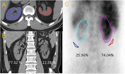 Estimation of Renal Function Using Unenhanced Computed Tomography in Upper Urinary Tract Stones Patients